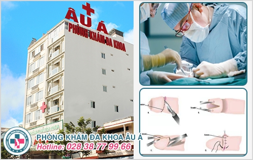 cắt bao quy đầu​