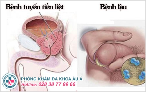 đái buốt ở nam