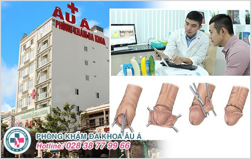 chi phí cắt bao quy đầu