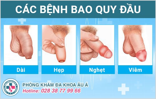 Sưng bao quy đầu dấu hiệu cảnh báo các bệnh ngoại khoa nam nguy hiểm