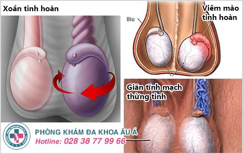 Đừng bỏ qua khi xuất hiện những cơn đau tinh hoàn trái