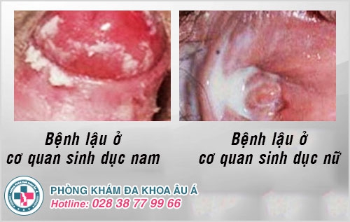 đi giải buốt