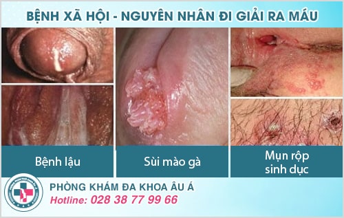 Đi giải ra máu ở nam và nữ cảnh báo điều gì? Có nguy hiểm không?