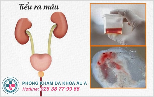 Đi giải đau, có máu là bệnh gì? Có nguy hiểm không?