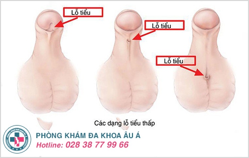Thông tin xung quanh vấn đề hẹp lỗ tiểu