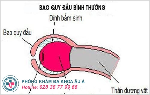 Dính bao quy đầu, bệnh lạ mà quen thuộc