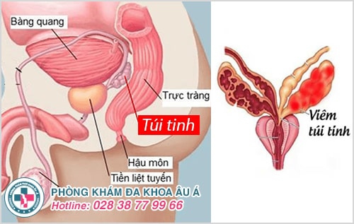 Bệnh viêm túi tinh và những điều cần biết