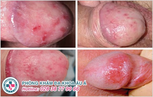 6 bệnh viêm nhiễm cơ quan sinh dục nam không nên bỏ qua