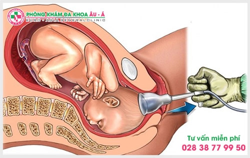 Hút thai được tiến hành như thế nào