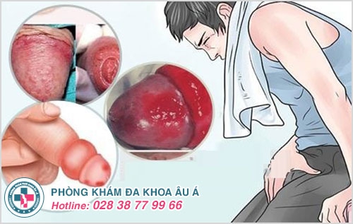 không lột bao quy đầu