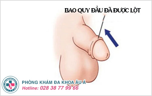 không lột bao quy đầu