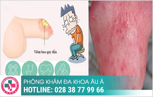 Lở loét bao quy đầu