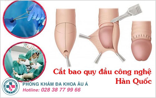 lột bao quy đầu