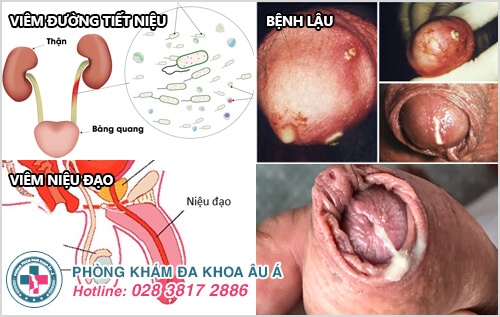 ngứa đường tiểu