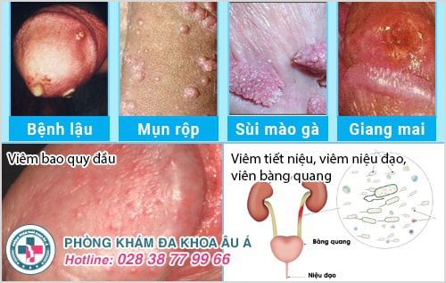 Tiết lộ dương vật bị nóng rát nam giới chớ xem thường