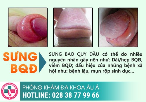 Đầu dương vật bị đỏ là đang mắc bệnh gì?