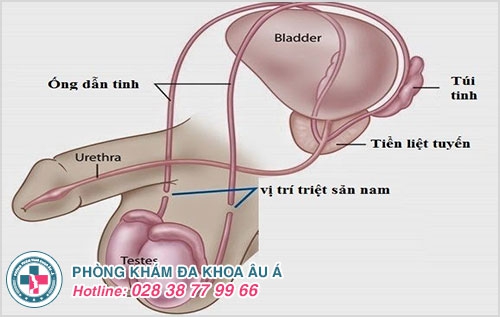 Ngứa ống dẫn tinh là bị bệnh gì? Điều trị như thế nào?