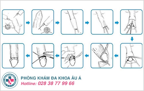 phẫu thuật cắt bao quy đầu