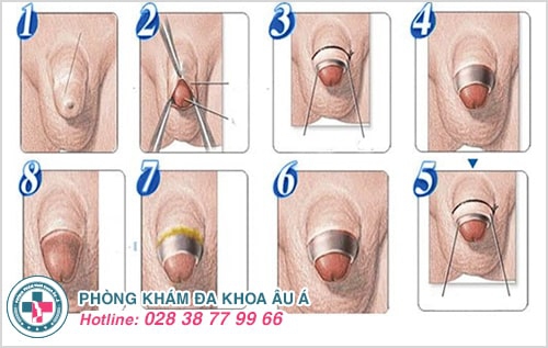 Cắt bao quy đầu bao nhiêu tiền?