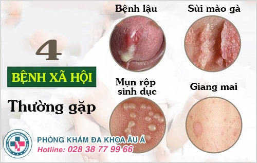 rát lỗ tiểu