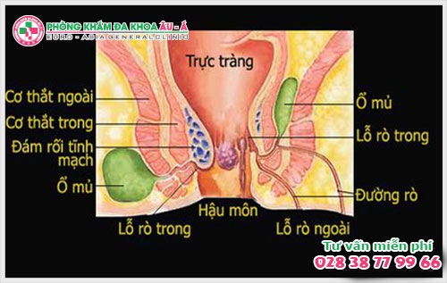 Nên làm gì khi bệnh rò hậu môn tái phát là điều cần thiết cần được người bệnh chú ý để kịp thời có biện pháp hỗ trợ điều trị .