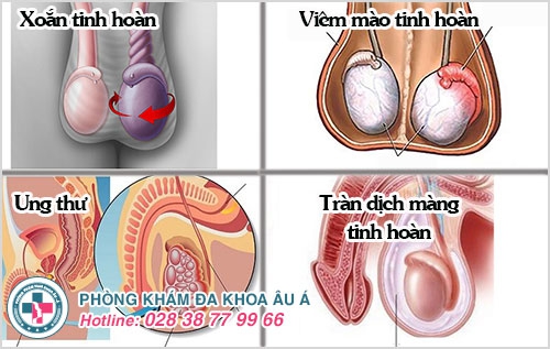 sưng tinh hoàn