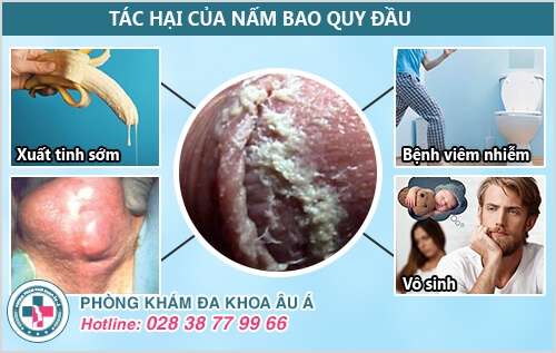 Nấm bao quy đầu 
