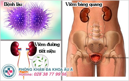 đi tiểu buốt ở nam giới