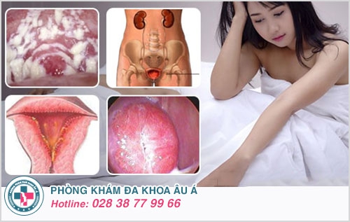 tiểu buốt sau quan hệ