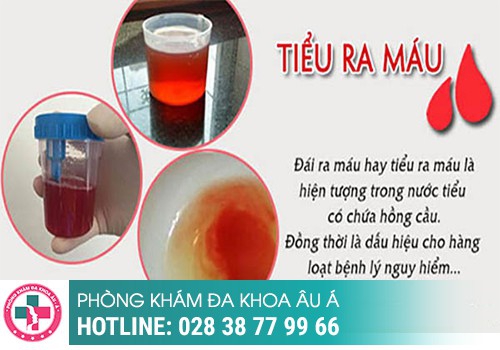 Đi tiểu ra máu sau quan hệ ở nam giới là bệnh gì?