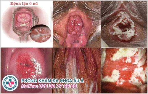 Tiểu ra máu ở phụ nữ là bệnh gì?