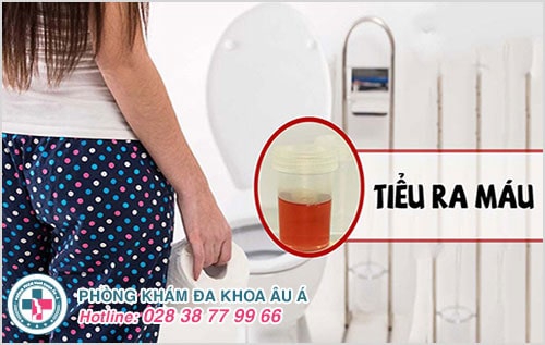 Tiểu ra máu ở phụ nữ là bệnh gì?