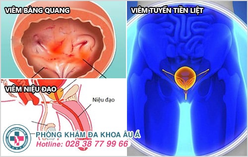 Tiểu rắt là dấu hiệu của bệnh gì?