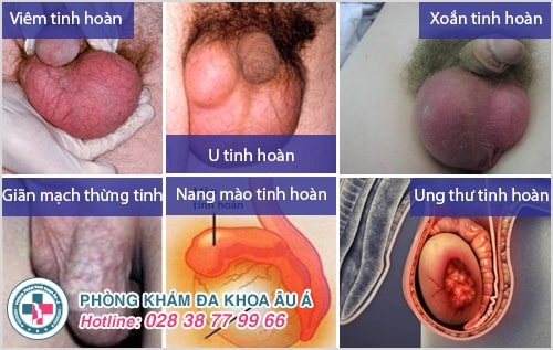 Tinh hoàn nổi hạch là bệnh gì? Có nguy hiểm không?