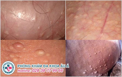 tinh hoàn nổi mụn
