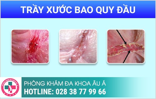 trầy xước bao quy đầu