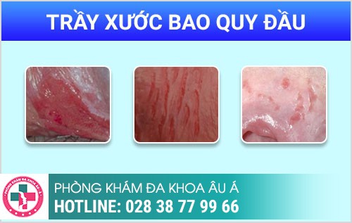 trầy xước bao quy đầu