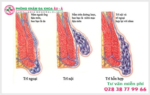 Theo các chuyên gia hậu môn – trực tràng khối u ở gần hậu môn là một hiện tượng rất thường gặp, bệnh gây ra nhiều phiền toái cho người bệnh.