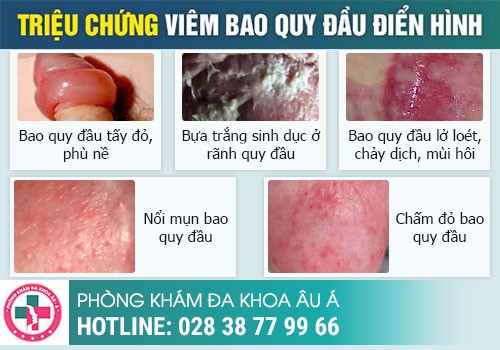 Đầu dương vật bị đỏ là đang mắc bệnh gì?