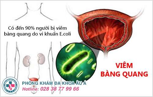 viêm bàng quang