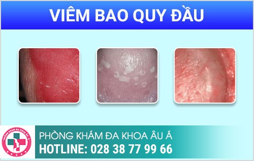 Viêm bao quy đầu