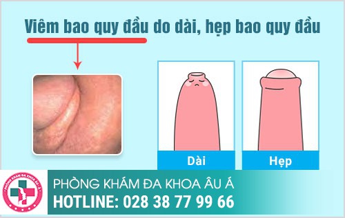 Viêm bao quy đầu