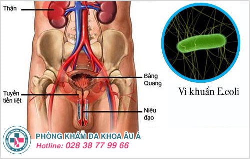 viêm đường tiểu