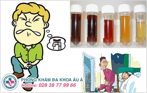 viêm đường tiểu