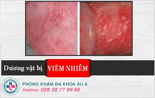 Viêm dương vật