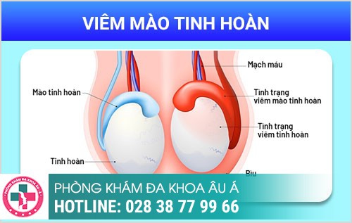 Viêm dương vật