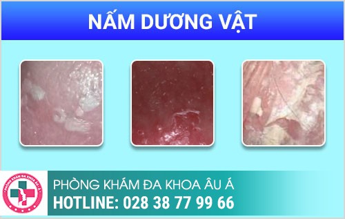 Viêm dương vật