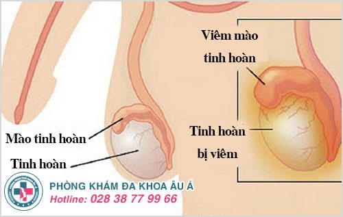 viêm mào tinh hoàn