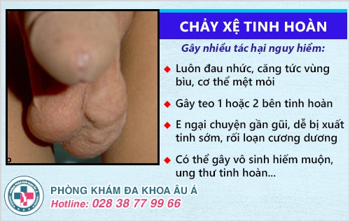 Nguyên Nhân Và Cách Khắc Phục Tình Trạng Xệ Tinh Hoàn