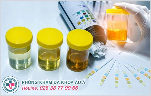 Xét nghiệm nước tiểu đơn giản